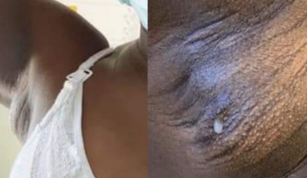 Woman produces Breast milk out of her armpit — New study reveals