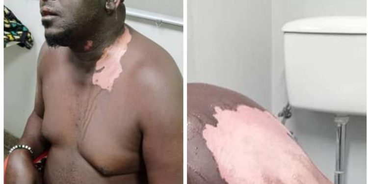 Woman Pours Hot Cooking Oil On Her Husband [PHOTOS]