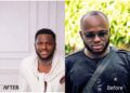 “Best $20,000 well spent” — Comedian I Go Save undergoes hair transplant